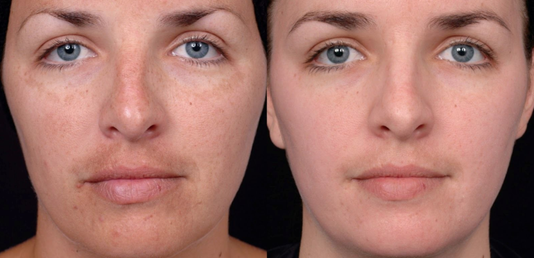 Mandelic Peel 1 - MEDLUX Mandelic Peel 1 - MEDLUX