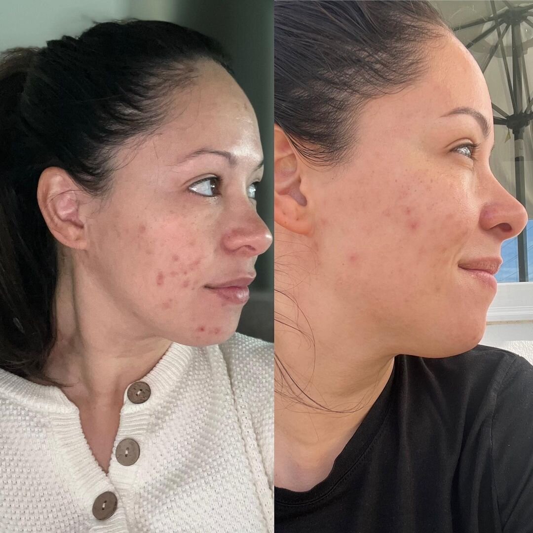 Gallery | Skincare results by Bloom Esthetics